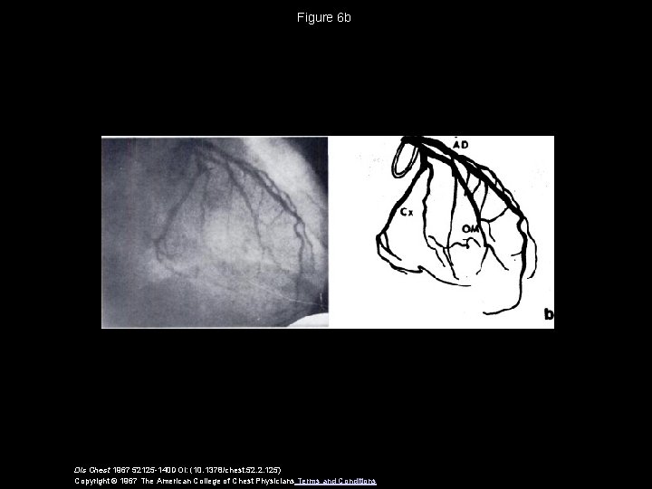 Figure 6 b Dis Chest 1967 52125 -140 DOI: (10. 1378/chest. 52. 2. 125)