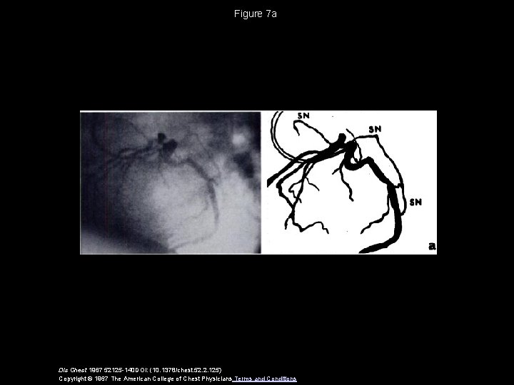 Figure 7 a Dis Chest 1967 52125 -140 DOI: (10. 1378/chest. 52. 2. 125)