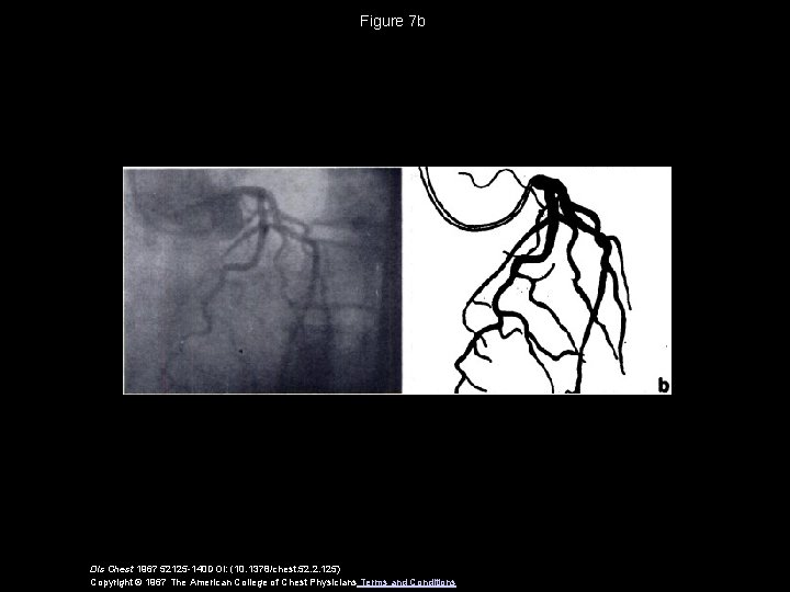 Figure 7 b Dis Chest 1967 52125 -140 DOI: (10. 1378/chest. 52. 2. 125)