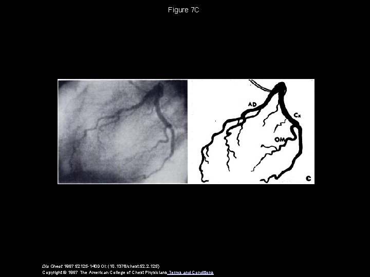 Figure 7 C Dis Chest 1967 52125 -140 DOI: (10. 1378/chest. 52. 2. 125)