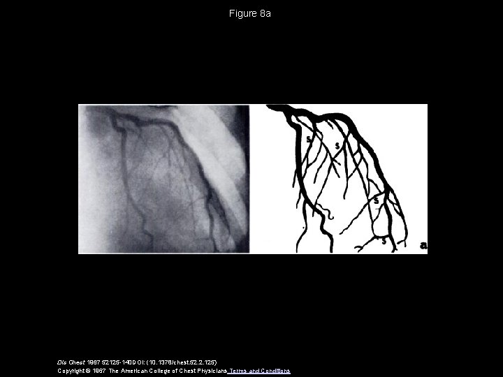 Figure 8 a Dis Chest 1967 52125 -140 DOI: (10. 1378/chest. 52. 2. 125)