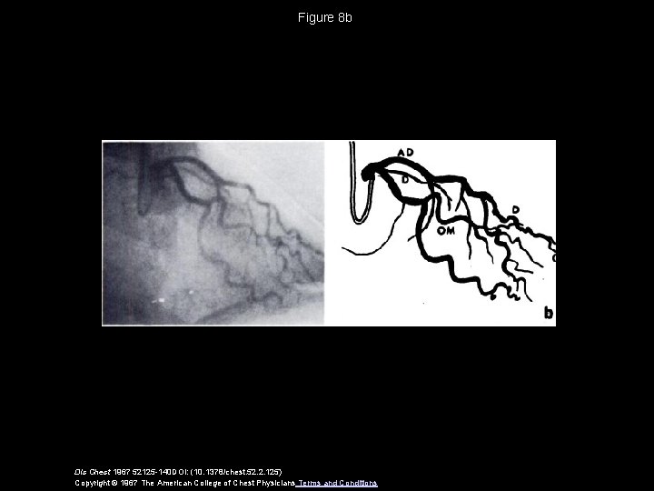 Figure 8 b Dis Chest 1967 52125 -140 DOI: (10. 1378/chest. 52. 2. 125)