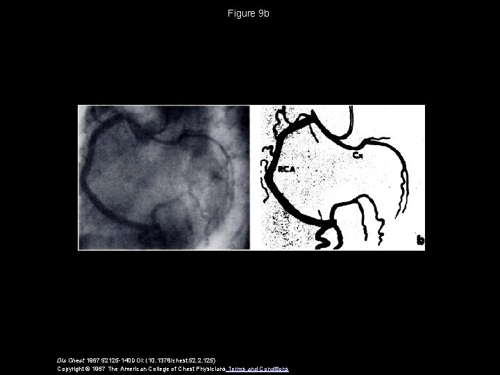 Figure 9 b Dis Chest 1967 52125 -140 DOI: (10. 1378/chest. 52. 2. 125)