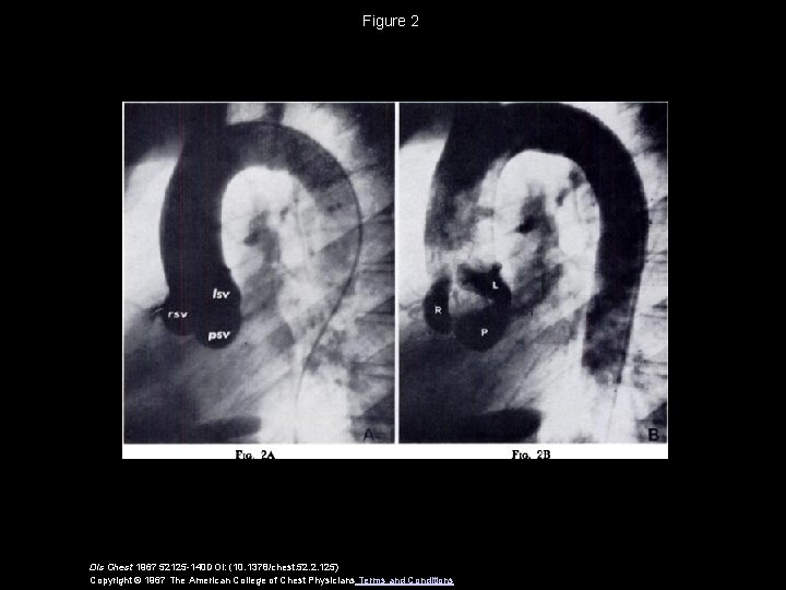 Figure 2 Dis Chest 1967 52125 -140 DOI: (10. 1378/chest. 52. 2. 125) Copyright