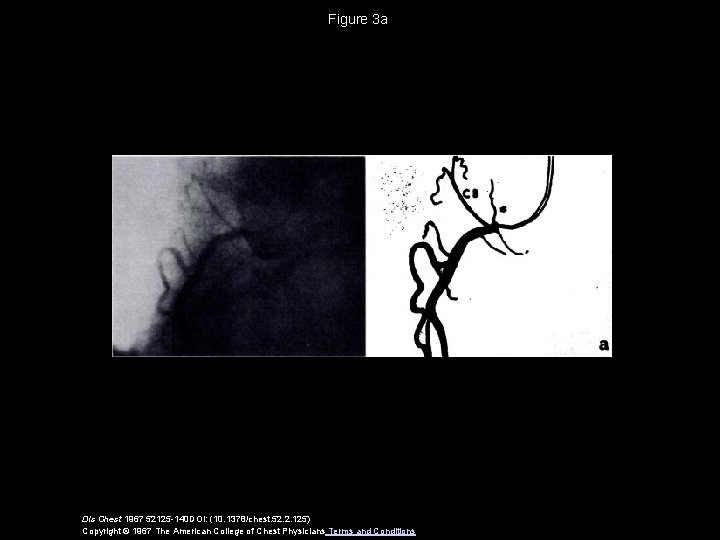 Figure 3 a Dis Chest 1967 52125 -140 DOI: (10. 1378/chest. 52. 2. 125)