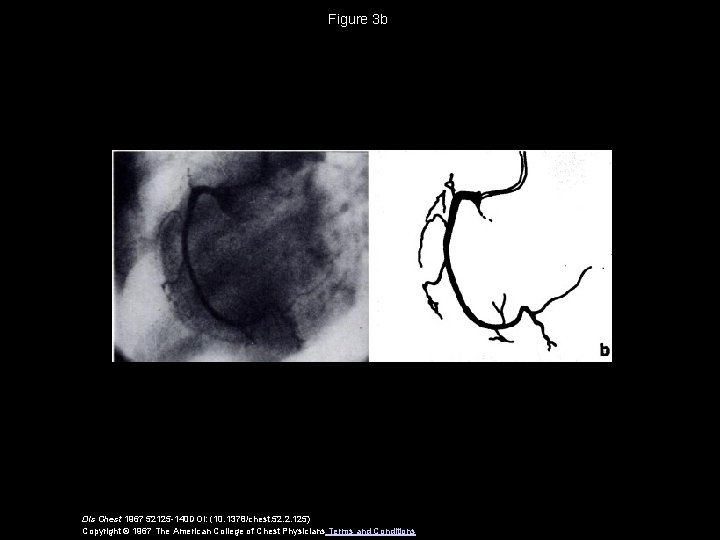 Figure 3 b Dis Chest 1967 52125 -140 DOI: (10. 1378/chest. 52. 2. 125)