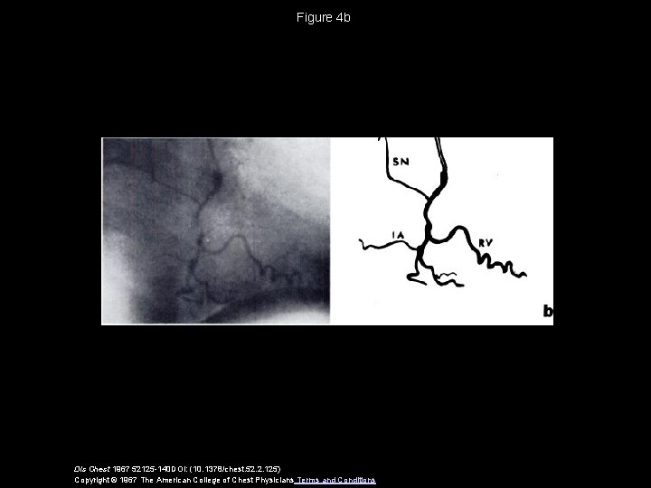 Figure 4 b Dis Chest 1967 52125 -140 DOI: (10. 1378/chest. 52. 2. 125)