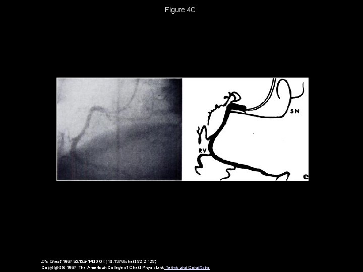 Figure 4 C Dis Chest 1967 52125 -140 DOI: (10. 1378/chest. 52. 2. 125)