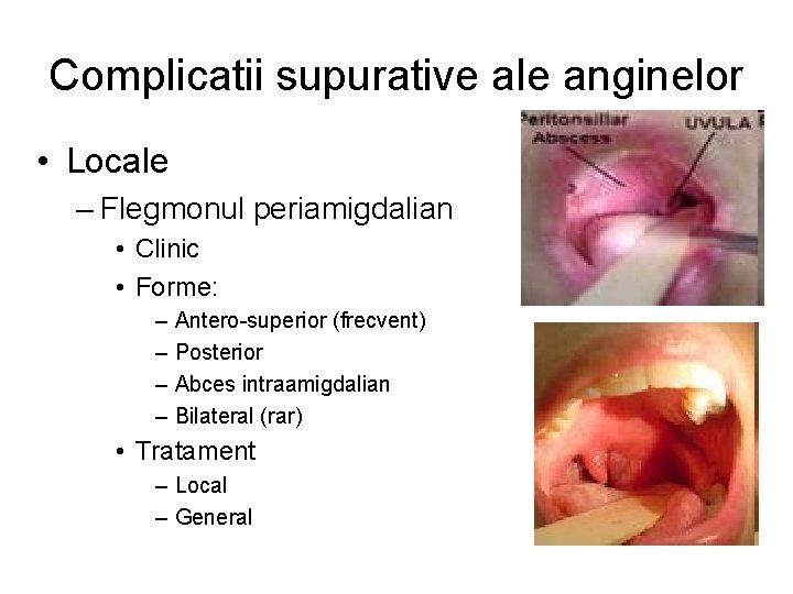 Complicatii supurative ale anginelor • Locale – Flegmonul periamigdalian • Clinic • Forme: –
