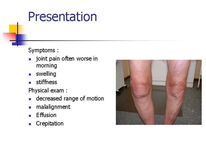 Presentation Symptoms : n joint pain often worse in morning n swelling n stiffness