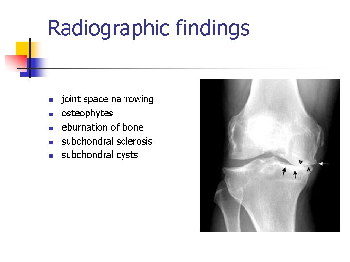 Radiographic findings n n n joint space narrowing osteophytes eburnation of bone subchondral sclerosis