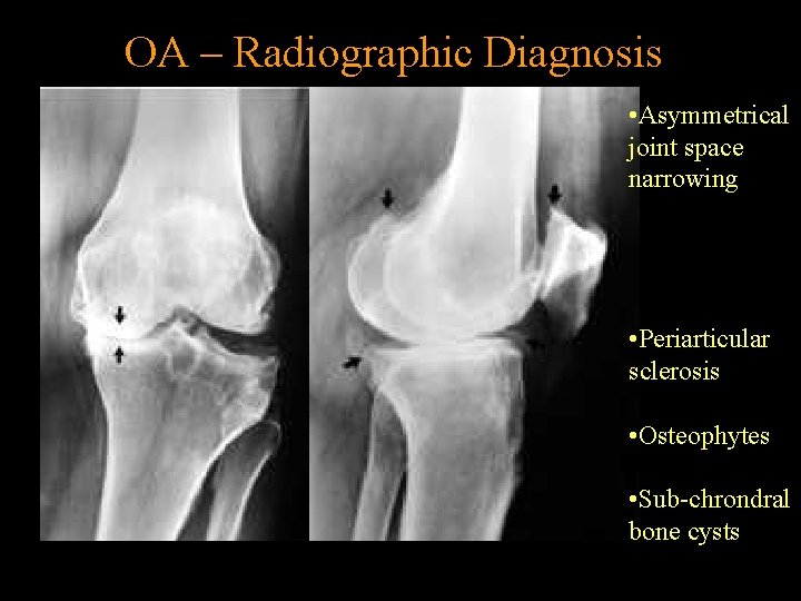 OA – Radiographic Diagnosis • Asymmetrical joint space narrowing • Periarticular sclerosis • Osteophytes