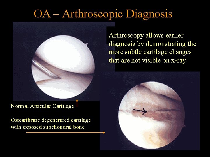 OA – Arthroscopic Diagnosis Arthroscopy allows earlier diagnosis by demonstrating the more subtle cartilage