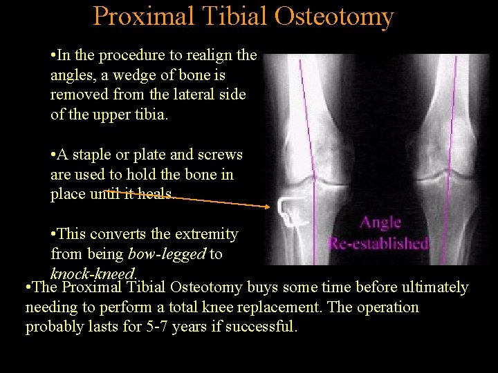 Proximal Tibial Osteotomy • In the procedure to realign the angles, a wedge of