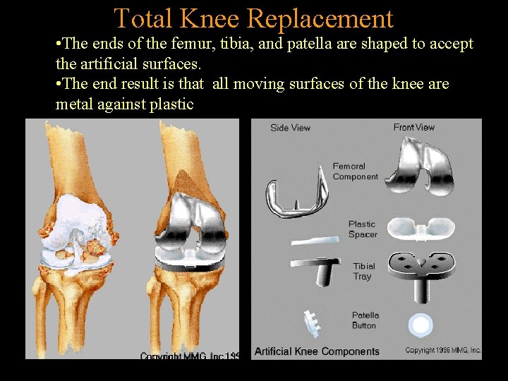 Total Knee Replacement • The ends of the femur, tibia, and patella are shaped