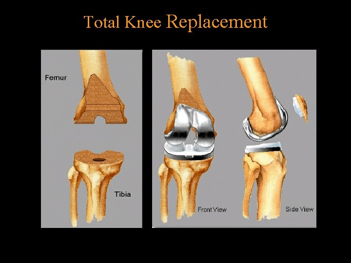 Total Knee Replacement 