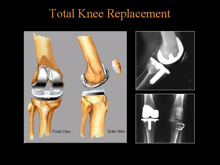 Total Knee Replacement 