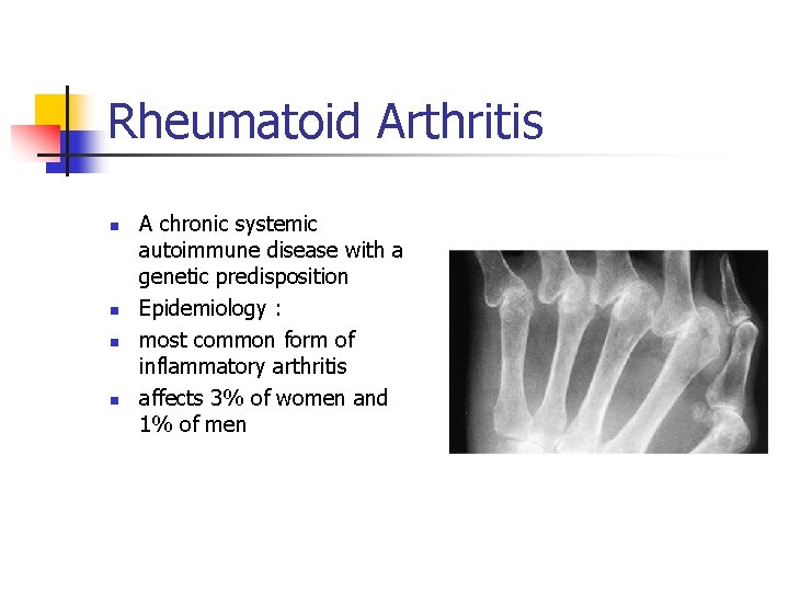 Rheumatoid Arthritis n n A chronic systemic autoimmune disease with a genetic predisposition Epidemiology