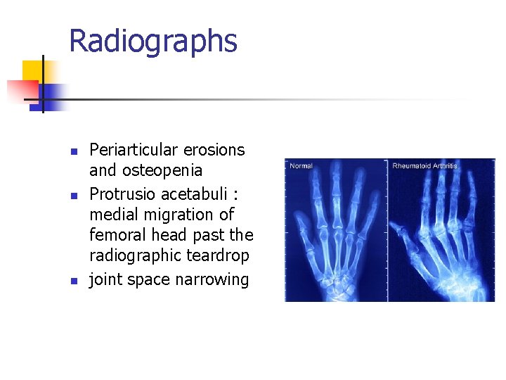 Radiographs n n n Periarticular erosions and osteopenia Protrusio acetabuli : medial migration of
