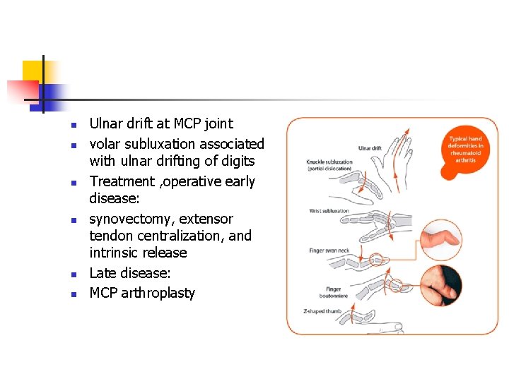 n n n Ulnar drift at MCP joint volar subluxation associated with ulnar drifting