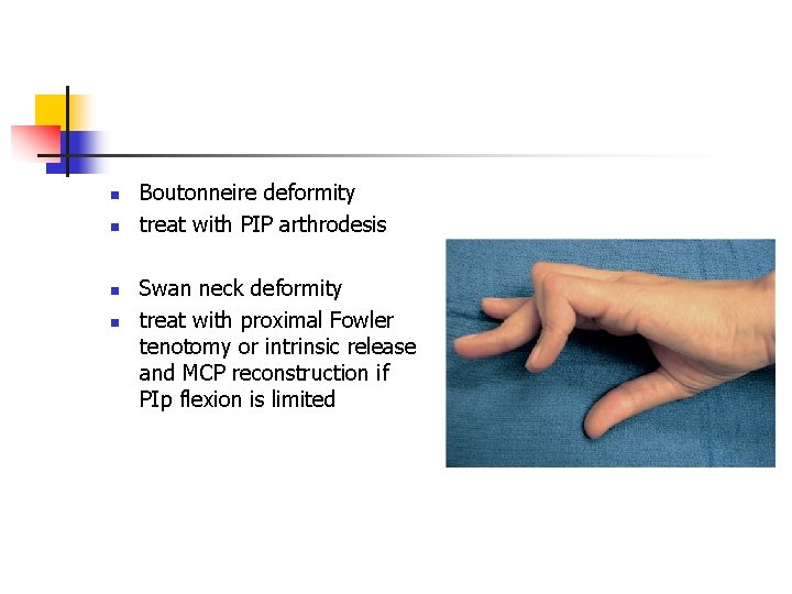 n n Boutonneire deformity treat with PIP arthrodesis Swan neck deformity treat with proximal