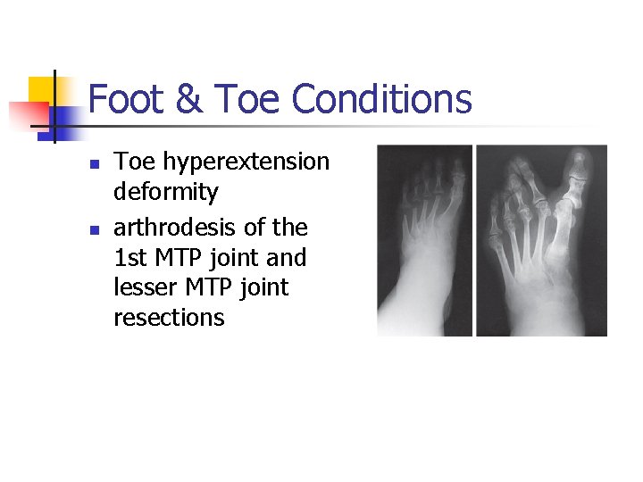 Foot & Toe Conditions n n Toe hyperextension deformity arthrodesis of the 1 st