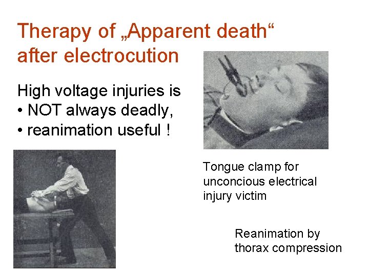 Therapy of „Apparent death“ after electrocution High voltage injuries is • NOT always deadly,
