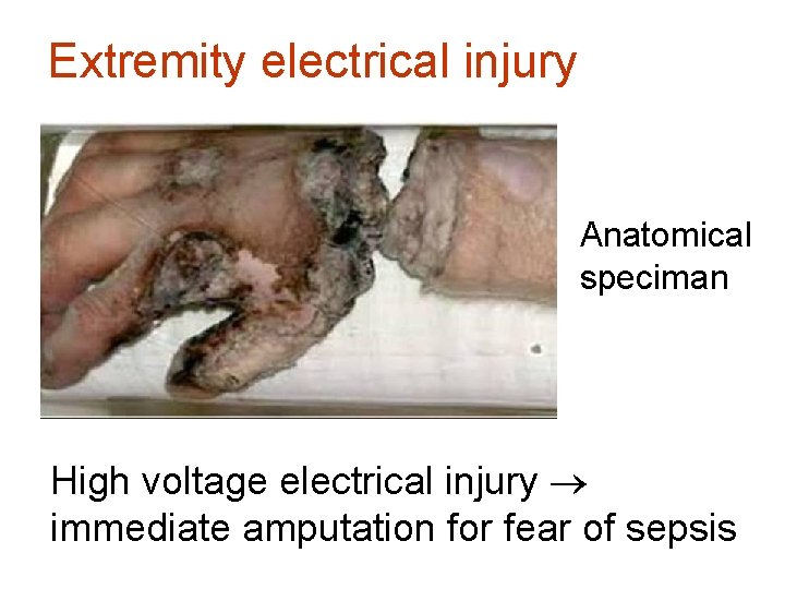 Extremity electrical injury Anatomical speciman High voltage electrical injury immediate amputation for fear of