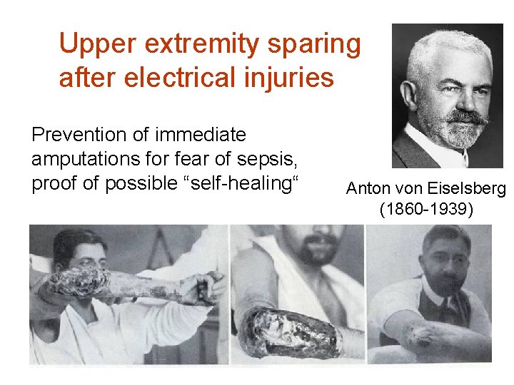 Upper extremity sparing after electrical injuries Prevention of immediate amputations for fear of sepsis,