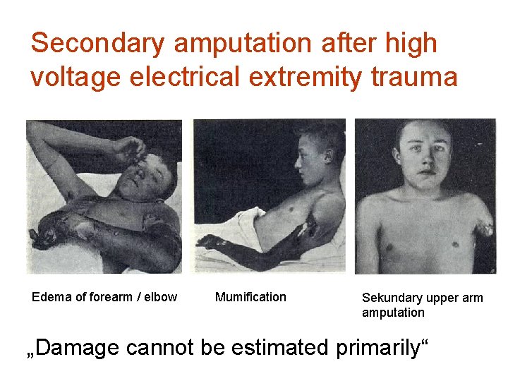 Secondary amputation after high voltage electrical extremity trauma Edema of forearm / elbow Mumification