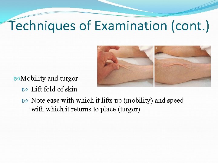 Techniques of Examination (cont. ) Mobility and turgor Lift fold of skin Note ease