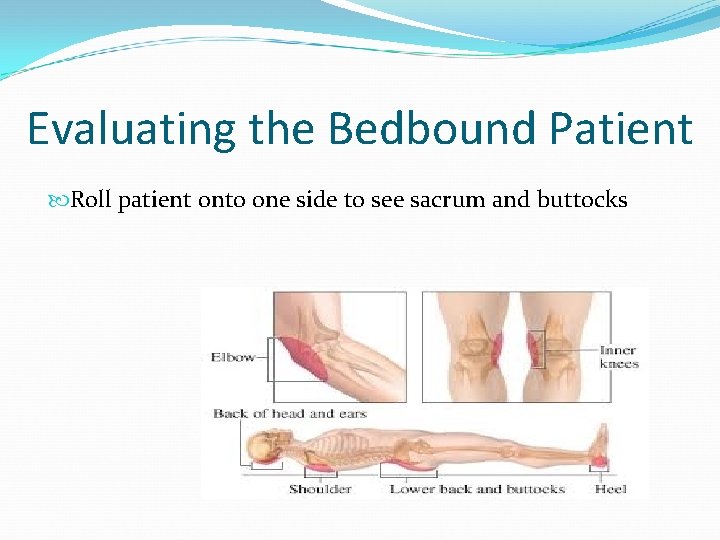 Evaluating the Bedbound Patient Roll patient onto one side to see sacrum and buttocks