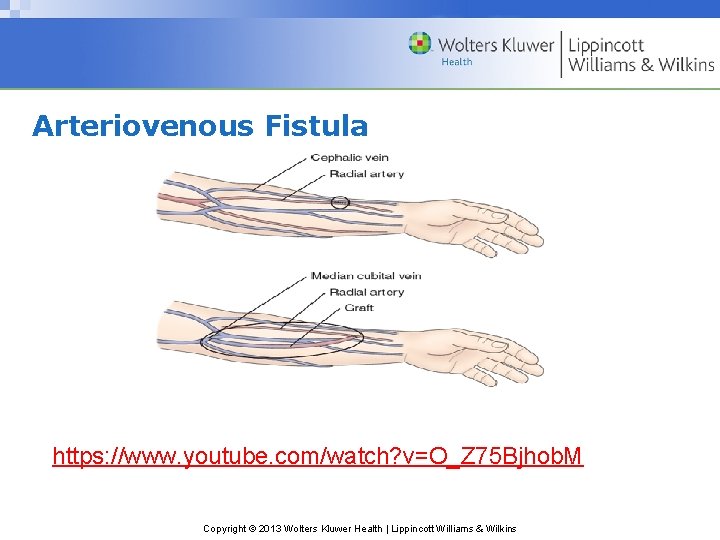 Arteriovenous Fistula https: //www. youtube. com/watch? v=O_Z 75 Bjhob. M Copyright © 2013 Wolters