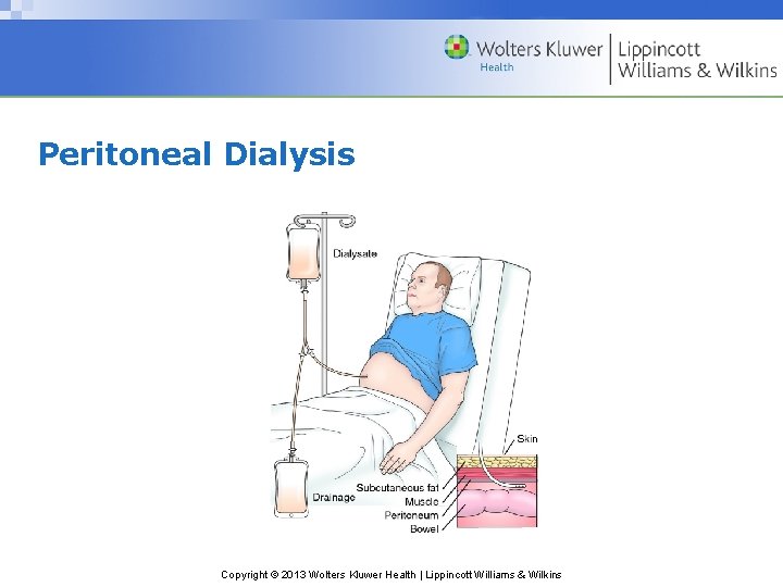 Peritoneal Dialysis Copyright © 2013 Wolters Kluwer Health | Lippincott Williams & Wilkins Peritoneal Dialysis Copyright © 2013 Wolters Kluwer Health | Lippincott Williams & Wilkins
