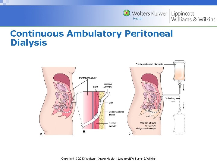 Continuous Ambulatory Peritoneal Dialysis Copyright © 2013 Wolters Kluwer Health | Lippincott Williams &