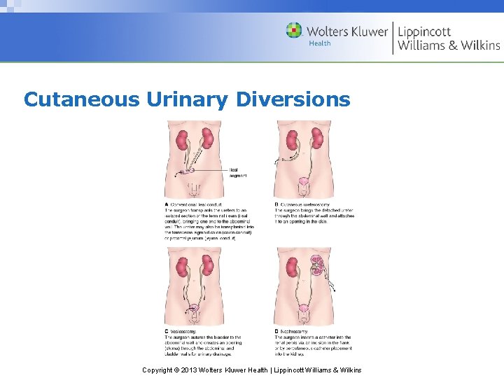 Cutaneous Urinary Diversions Copyright © 2013 Wolters Kluwer Health | Lippincott Williams & Wilkins