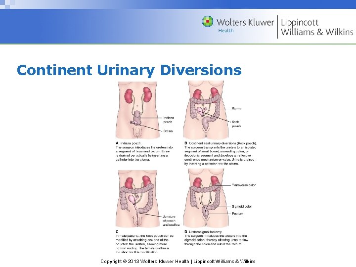 Continent Urinary Diversions Copyright © 2013 Wolters Kluwer Health | Lippincott Williams & Wilkins