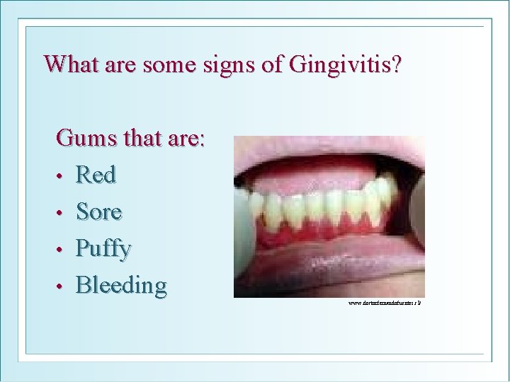 What are some signs of Gingivitis? Gums that are: • Red • Sore •