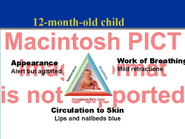 12 -month-old child Appearance Alert but agitated Work of Breathing Mild retractions Circulation to