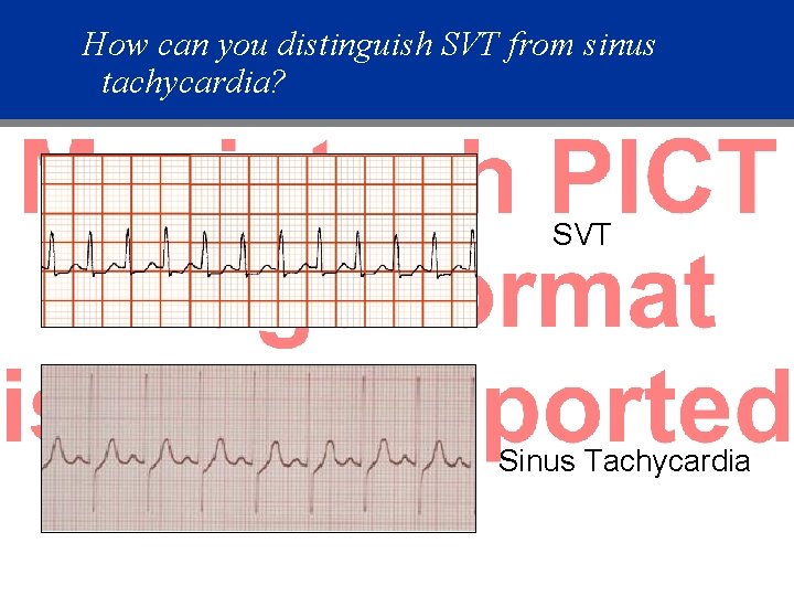 How can you distinguish SVT from sinus tachycardia? SVT Sinus Tachycardia 