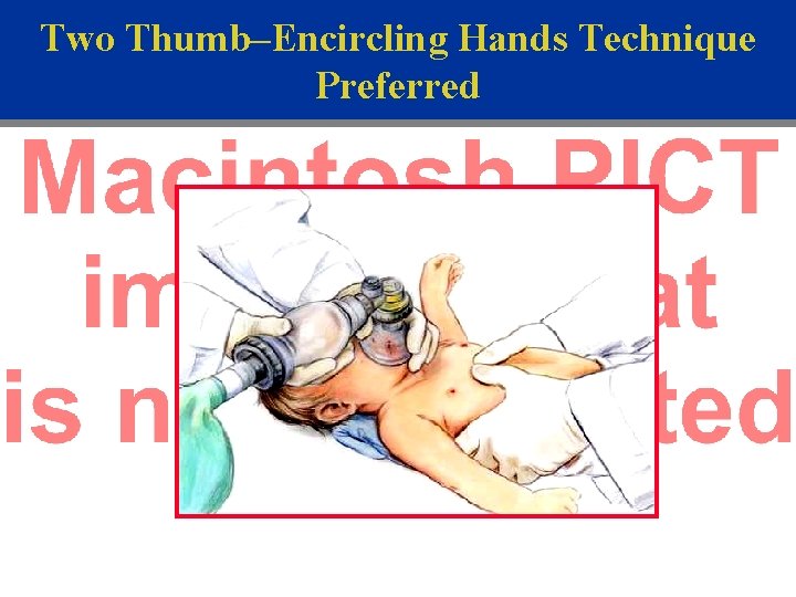 Two Thumb–Encircling Hands Technique Preferred 