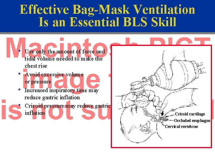 Effective Bag-Mask Ventilation Is an Essential BLS Skill • • Use only the amount