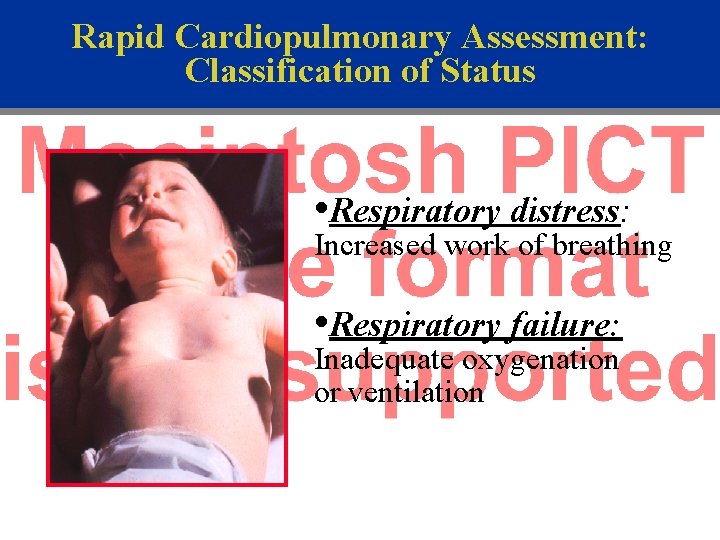 Rapid Cardiopulmonary Assessment: Classification of Status • Respiratory distress: Increased work of breathing •