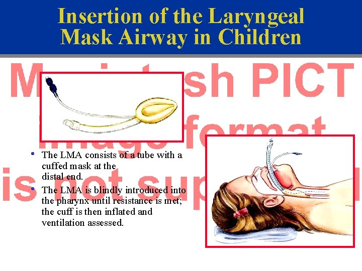 Insertion of the Laryngeal Mask Airway in Children • • The LMA consists of