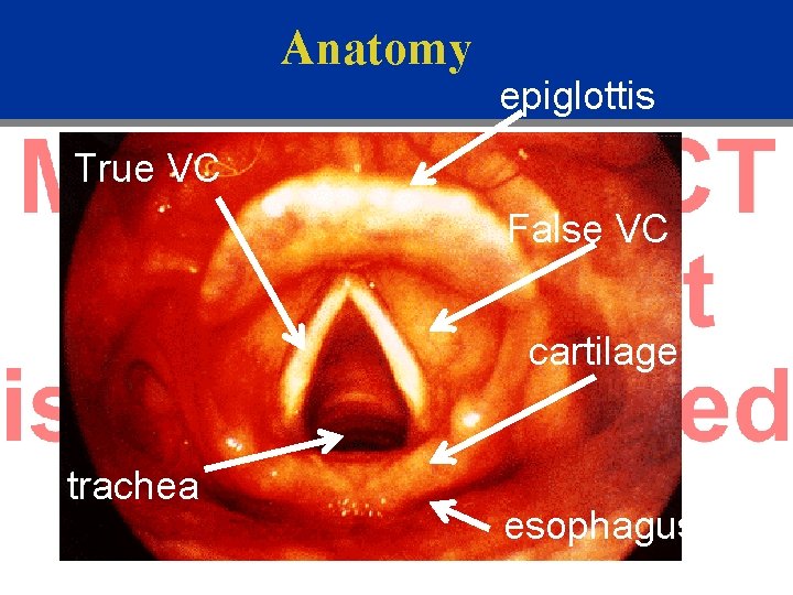 Anatomy epiglottis True VC False VC cartilage trachea esophagus 