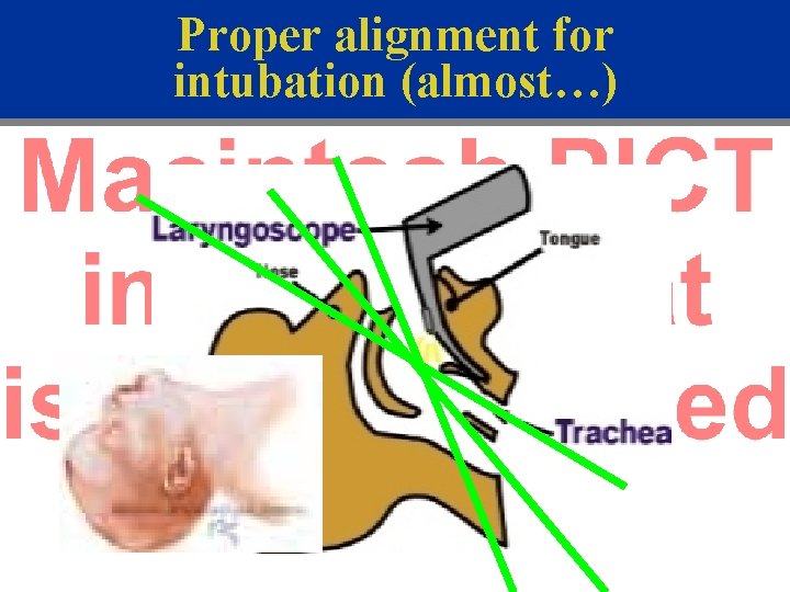 Proper alignment for intubation (almost…) 