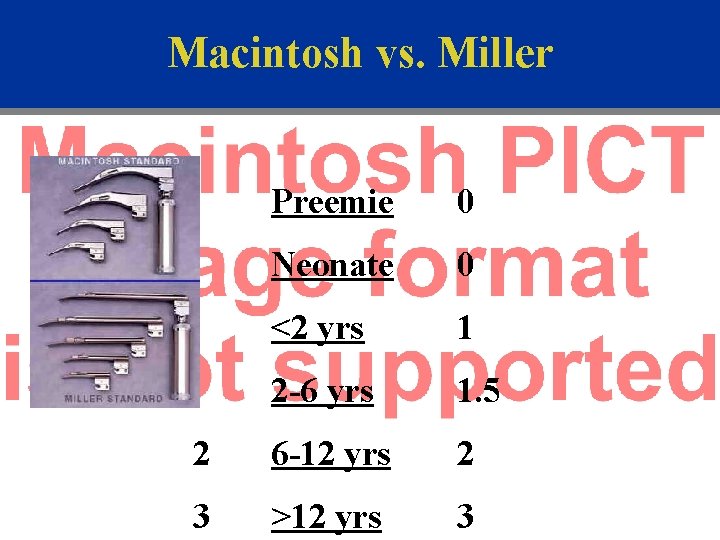 Macintosh vs. Miller Preemie 0 Neonate 0 <2 yrs 1 2 -6 yrs 1.