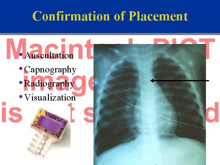 Confirmation of Placement • Auscultation • Capnography • Radiography • Visualization 