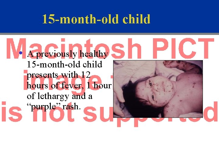 15 -month-old child • A previously healthy 15 -month-old child presents with 12 hours