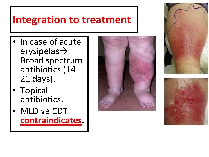 Integration to treatment • In case of acute erysipelas Broad spectrum antibiotics (14‐ 21